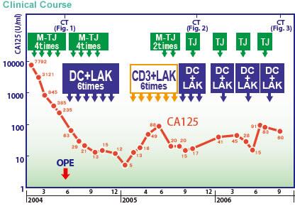 日本免疫細胞治療(瀨田診所)：卵巢癌，女，51歲