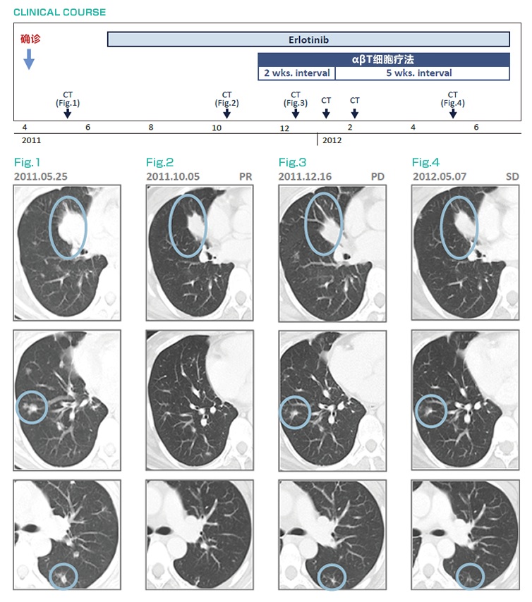 厄洛替尼耐藥后，免疫細(xì)胞治療（αβT細(xì)胞療法）治療后維持穩(wěn)定狀態(tài)的肺癌(IV期)案例