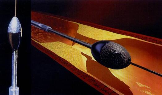 旋磨治療醫(yī)期示意圖