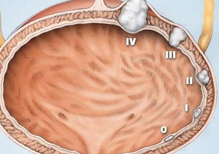 日本專家談腫瘤?膀胱癌