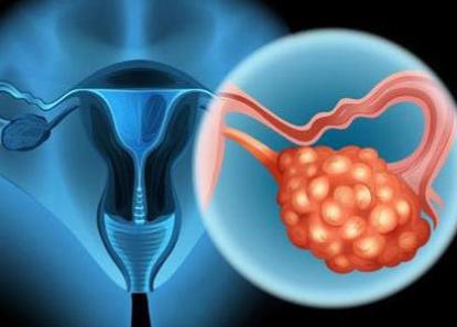 日本專家談腫瘤?卵巢癌