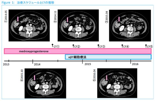 子宮內膜癌使用免疫細胞治療效果如何？